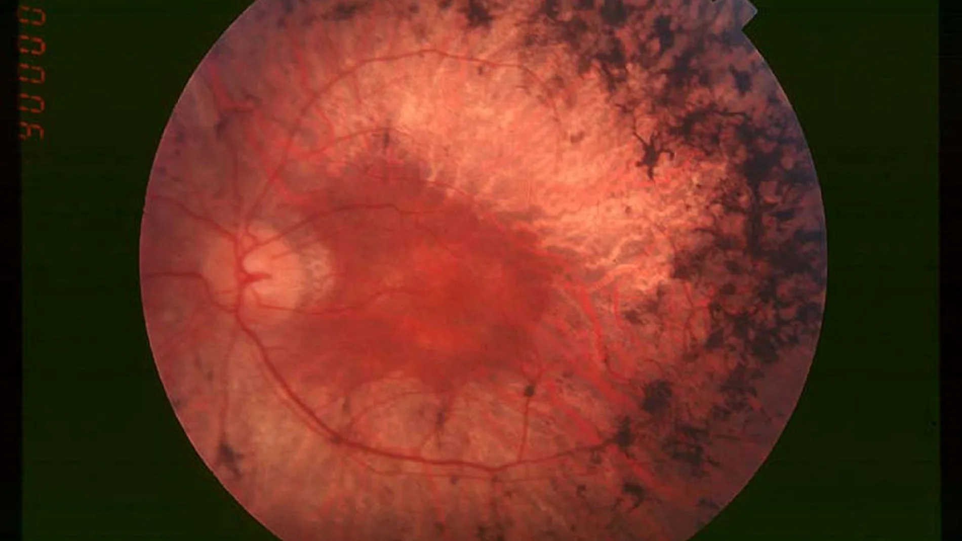 Fondo de ojo de un paciente afectado con retinosis pigmentaria. Obsérvese la acumulación de pigmento en la periferia de la retina
