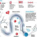 La esclerosis múltiple es una enfermedad de adultos jóvenes / Infografía LA RAZÓN