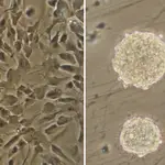 Investigadores del CONICET lograron un importante avance sobre los mecanismos de origen y crecimiento del glioblastoma, una variante de cáncer muy agresiva