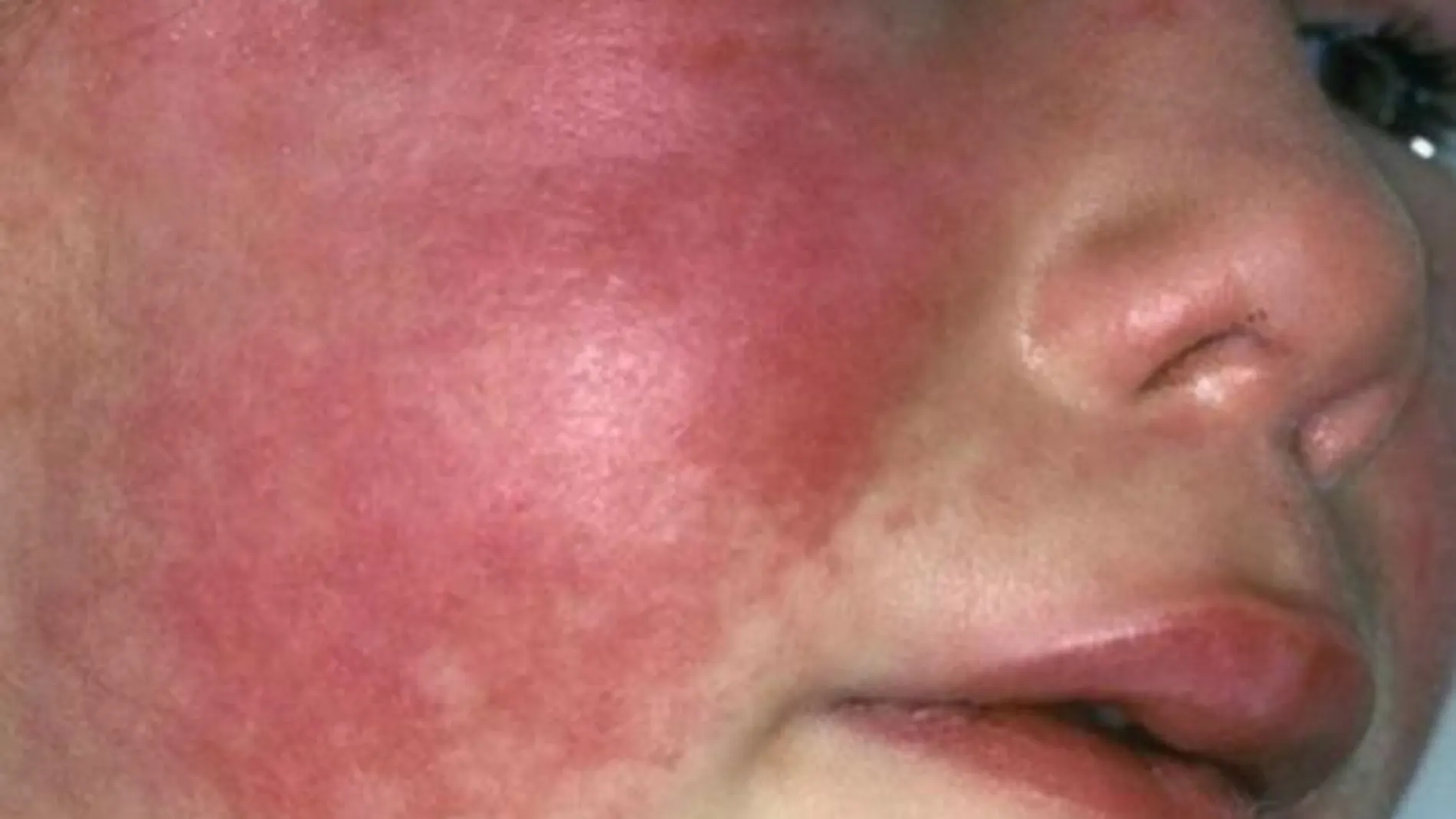 ¿Qué es la escarlatina? ¿por qué ha vuelto? ¿cuáles son sus síntomas? ¿Y su tratamiento?