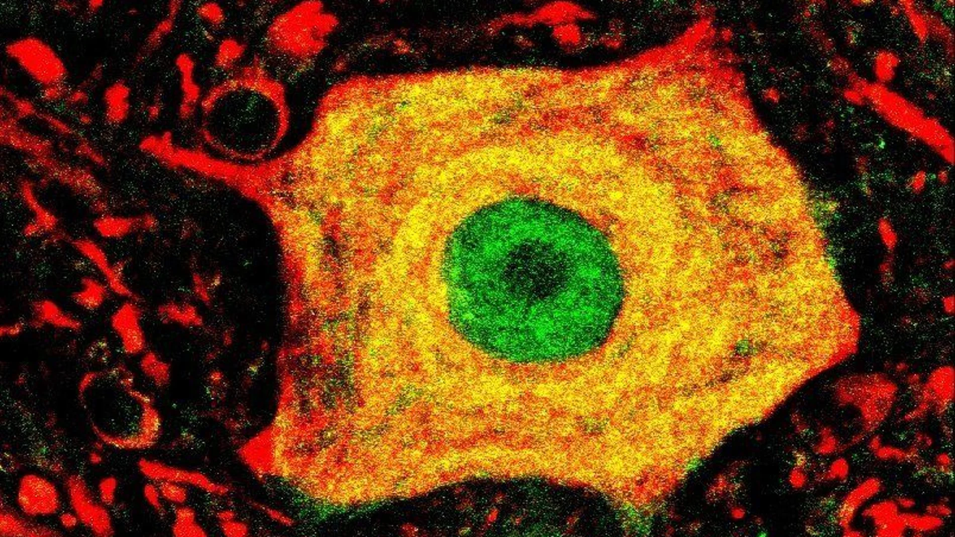 Detalle de una neurona afectada por la Esclerosis Lateral Amiotrófica (ELA)