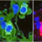 Los virus AAV9 (en rojo) llevan el gen de la telomerasa a las células alveolares afectadas (en verde). Las que han sido infectadas se observan en amarillo