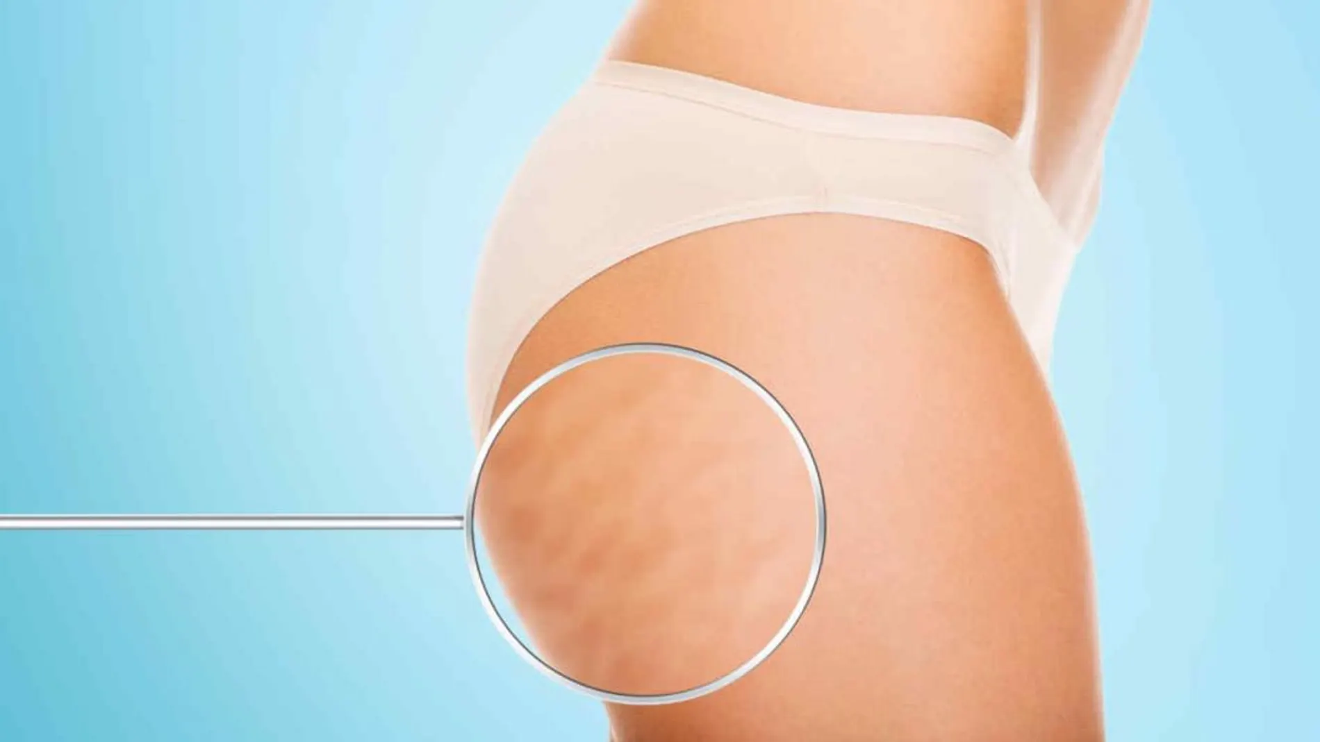 La predisposición genética, así como diferentes factores hormonales suelen ser algunas de las causas más habituales de la celulitis