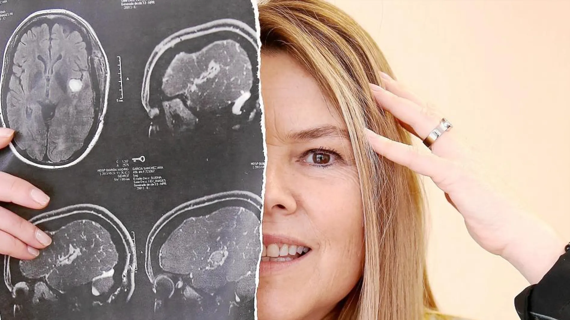 Ana sostiene la radiografía que le hicieron tras extirparle un glioblastoma