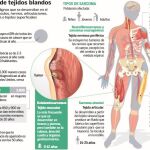 Sarcomas, los tumores ocultos
