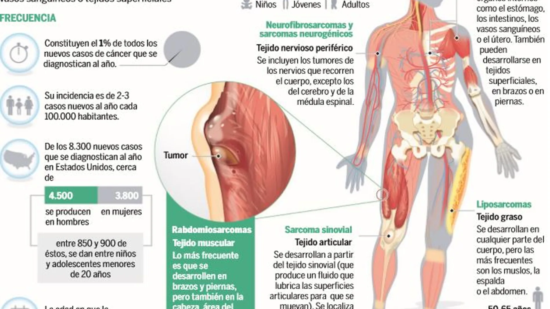Sarcomas, los tumores ocultos