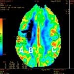 Imagen de archivo de un cerebro a través de una resonancia
