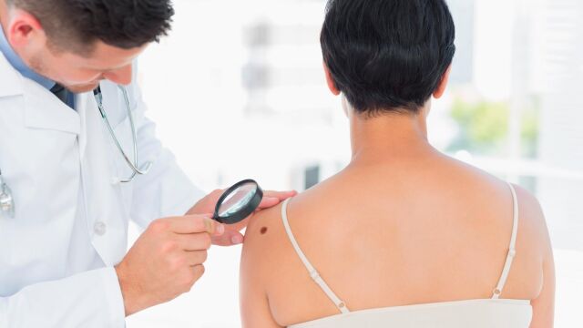 Más de 6.000 casos de melanoma al año en España