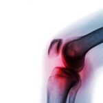 La artritis reumatoide es un trastorno inflamatorio autoinmunitario crónico que afecta al 1% de la población mundial y puede conllevar a graves problemas de salud.