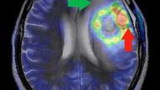 Imagen de un glioblastoma múltiple, el más común y maligno de los tumores cerebrales