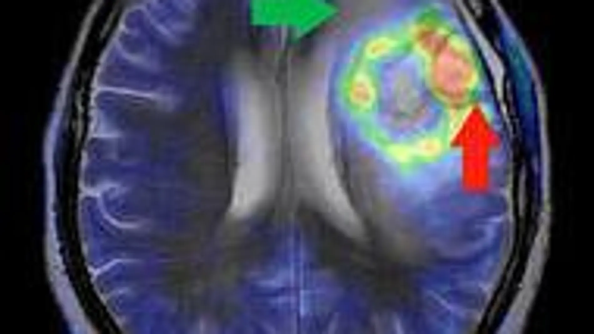 Imagen de un glioblastoma múltiple, el más común y maligno de los tumores cerebrales