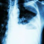El 35,2% de los pacientes responde a la terapia | Dreamstime