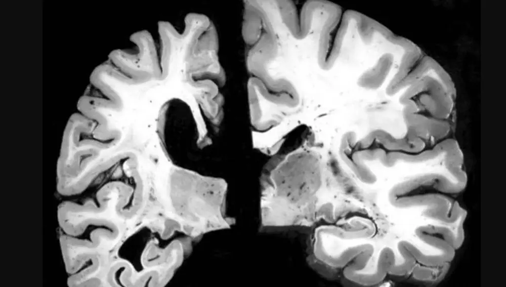 En la imagen de la izquierda un cerebro con Alzheimer. A la derecha, el cerebro sin enfermedad