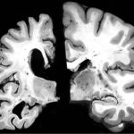 En la imagen de la izquierda un cerebro con Alzheimer. A la derecha, el cerebro sin enfermedad