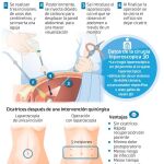 La cirugía laparoscopica 3D permite la utilización de una doble cámara, un procesador específico y unas gafas de visión 3D