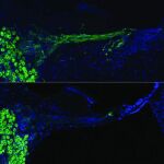 Comparación del nervio coclear tras la terapia génica de neurotrofina, frente a la cóclea sin tratar del mismo animal (abajo).