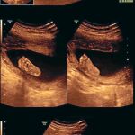 El Comité de Bioética respalda la reforma del aborto de Gallardón