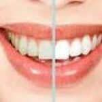 El «boom» del blanqueamiento dental esconde riesgos