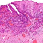 Microcarcinoma de esófago