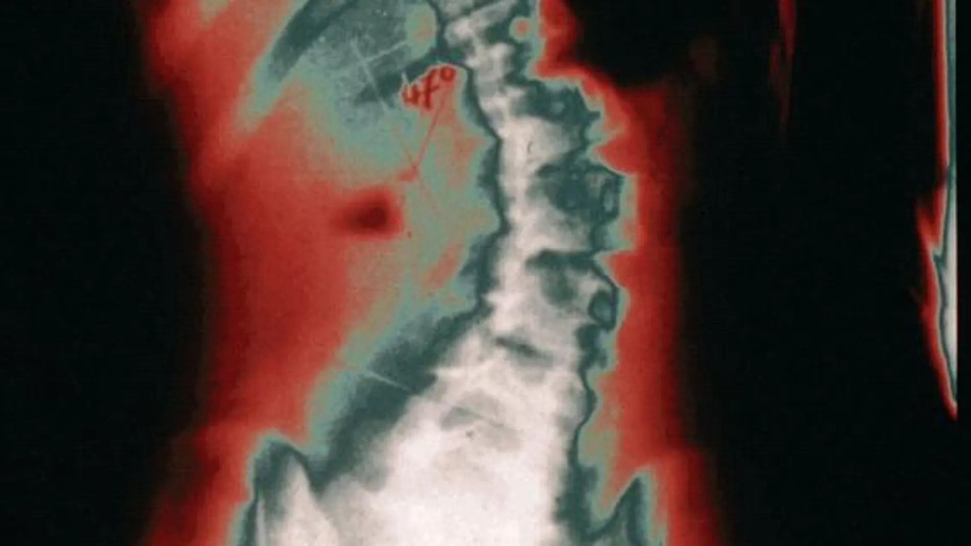 Radiografía de una columna vertebral con escoliosis