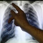 Radiografía de dos pulmones infectados por tuberculosis