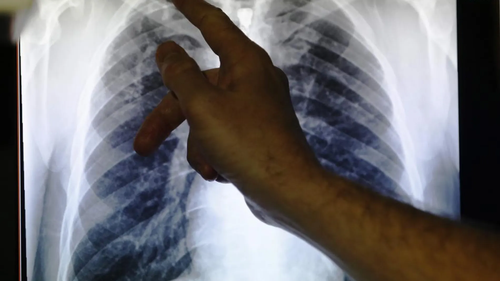 Radiografía de dos pulmones infectados por tuberculosis
