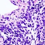 Vista microscópica de una biopsia de carcinoma de pulmón de células pequeñas