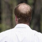 Casi el 50 % de la población española padece alopecia