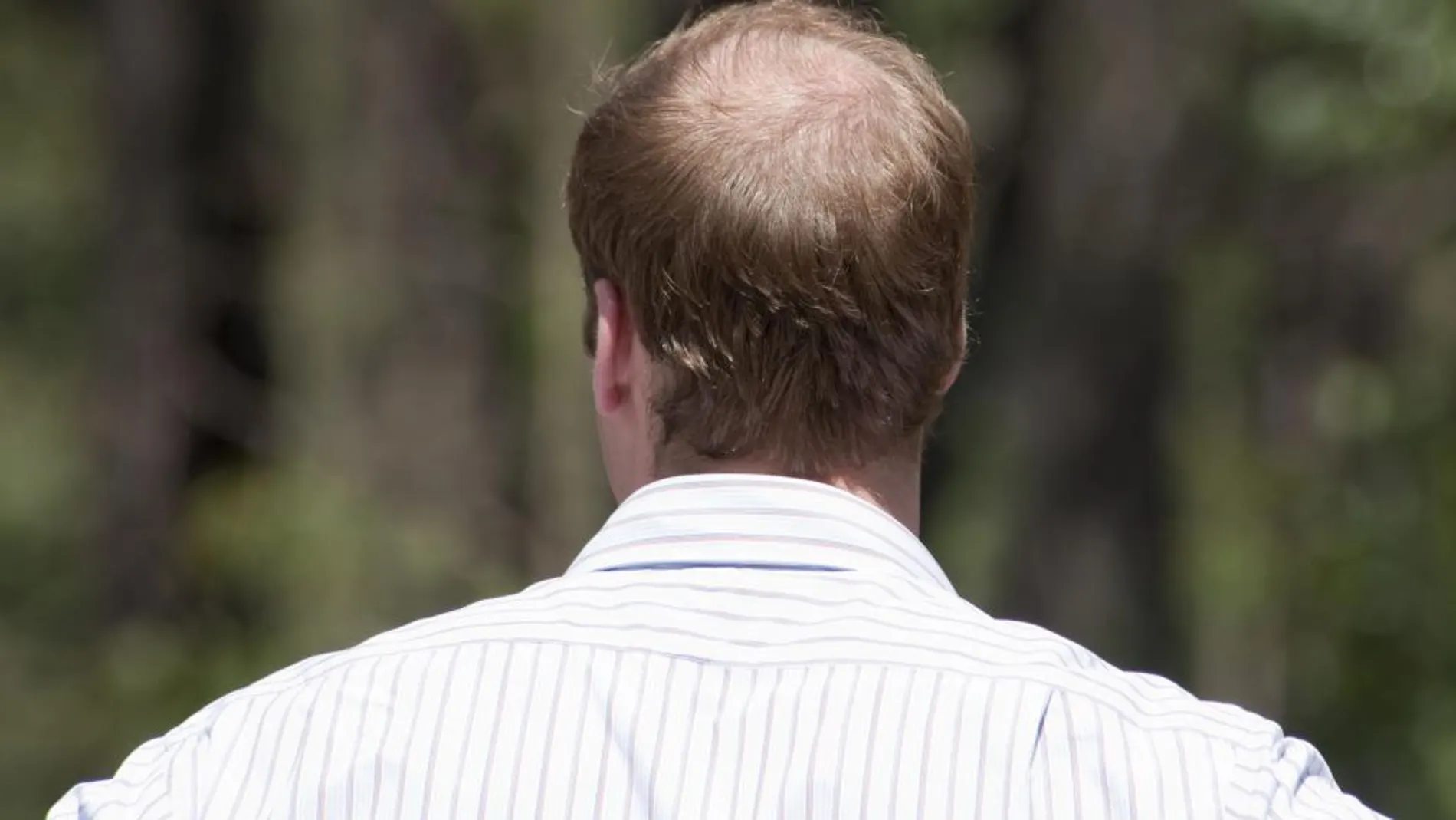 Casi el 50 % de la población española padece alopecia