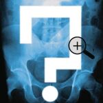 Una gran alianza contra el cáncer de colon