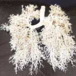 Vivir con pulmones sin oxígeno