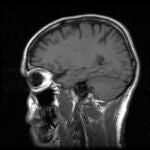 Combinar terapias contra el tumor cerebral / SXC