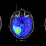 Los científicos eliminaron con éxito una proteína de la región del cerebro responsable de recordar el miedo en las pruebas con ratones