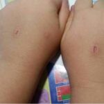 Heridas provocadas por el “abecedario del diablo”