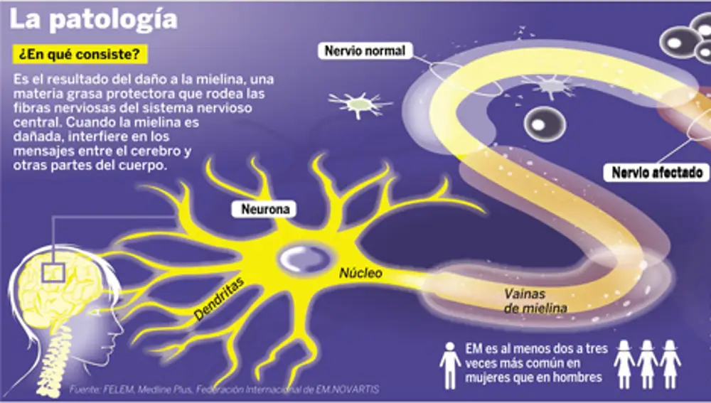 ¿Qué es la esclerosis múltiple, la enfermedad que María Pombo ha confesado padecer?