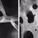 A la izquierda, un hueso con osteoporosis; a la derecha, un hueso sano