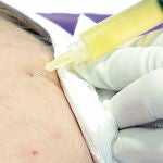 Células madre para borrar las arrugas