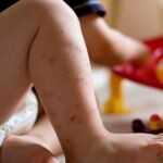 Las picaduras de los mosquitos son muy molestas y suelen durar varios días