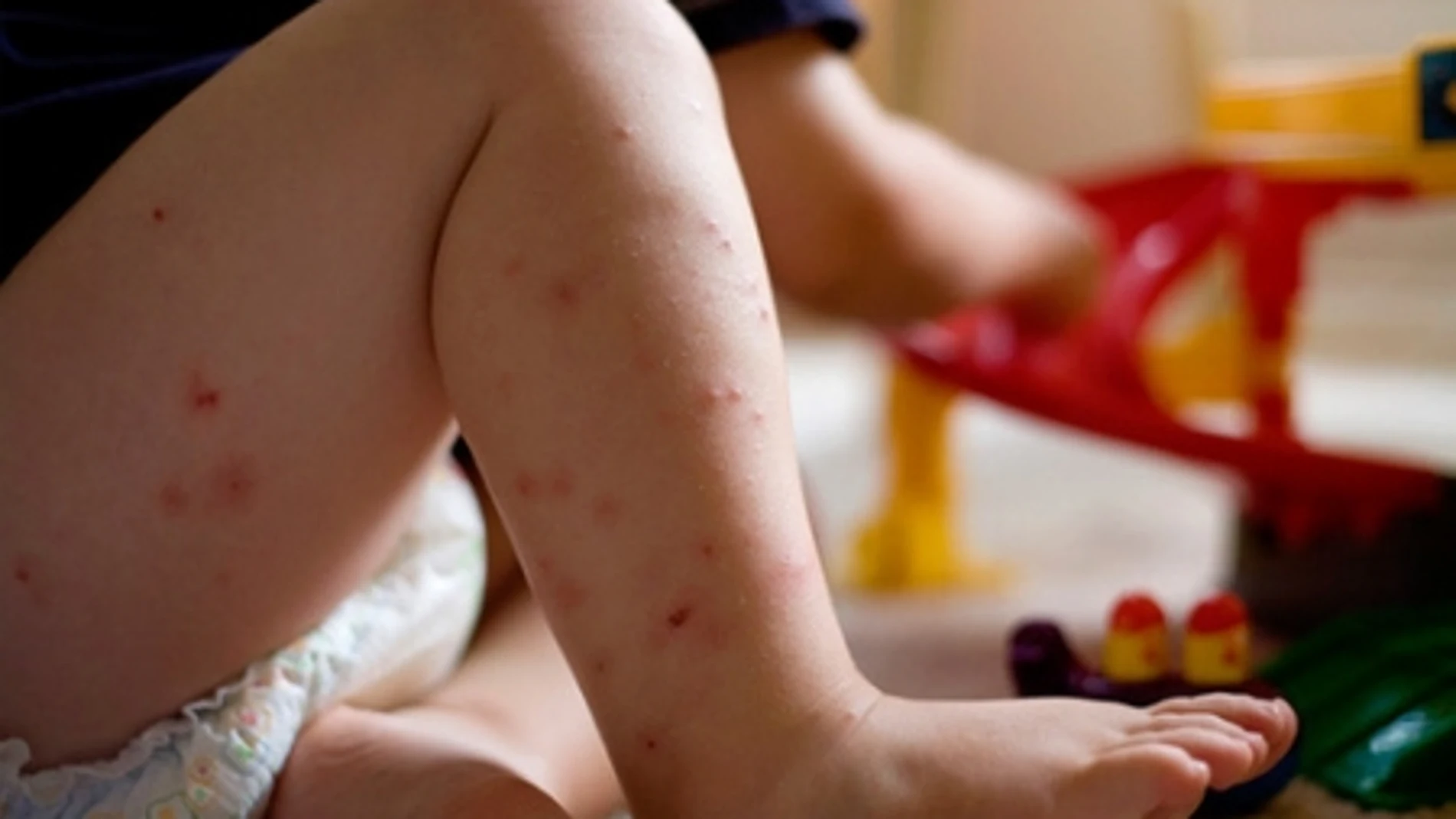 Las picaduras de los mosquitos son muy molestas y suelen durar varios días