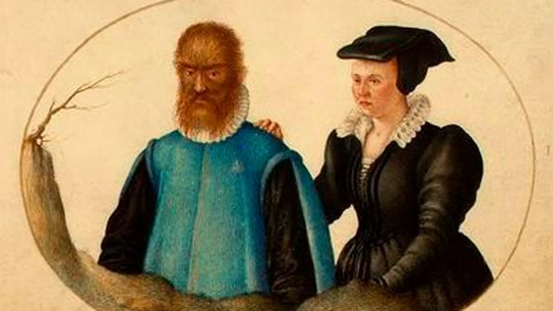 Las personas con hipertricosis están completamente cubiertas de un vello muy fino