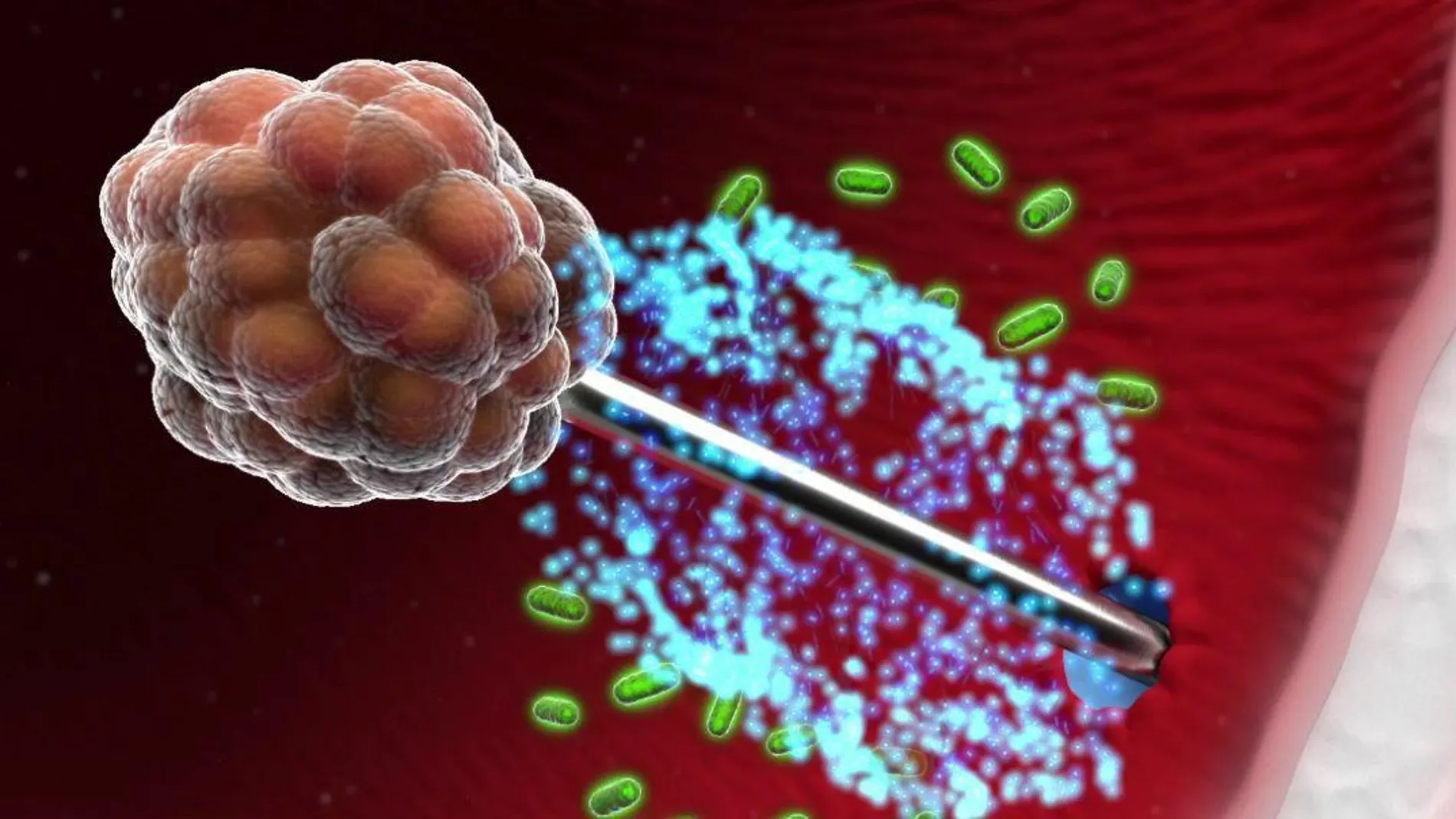 Biopsia de plata para diagnosticar el cáncer de próstata