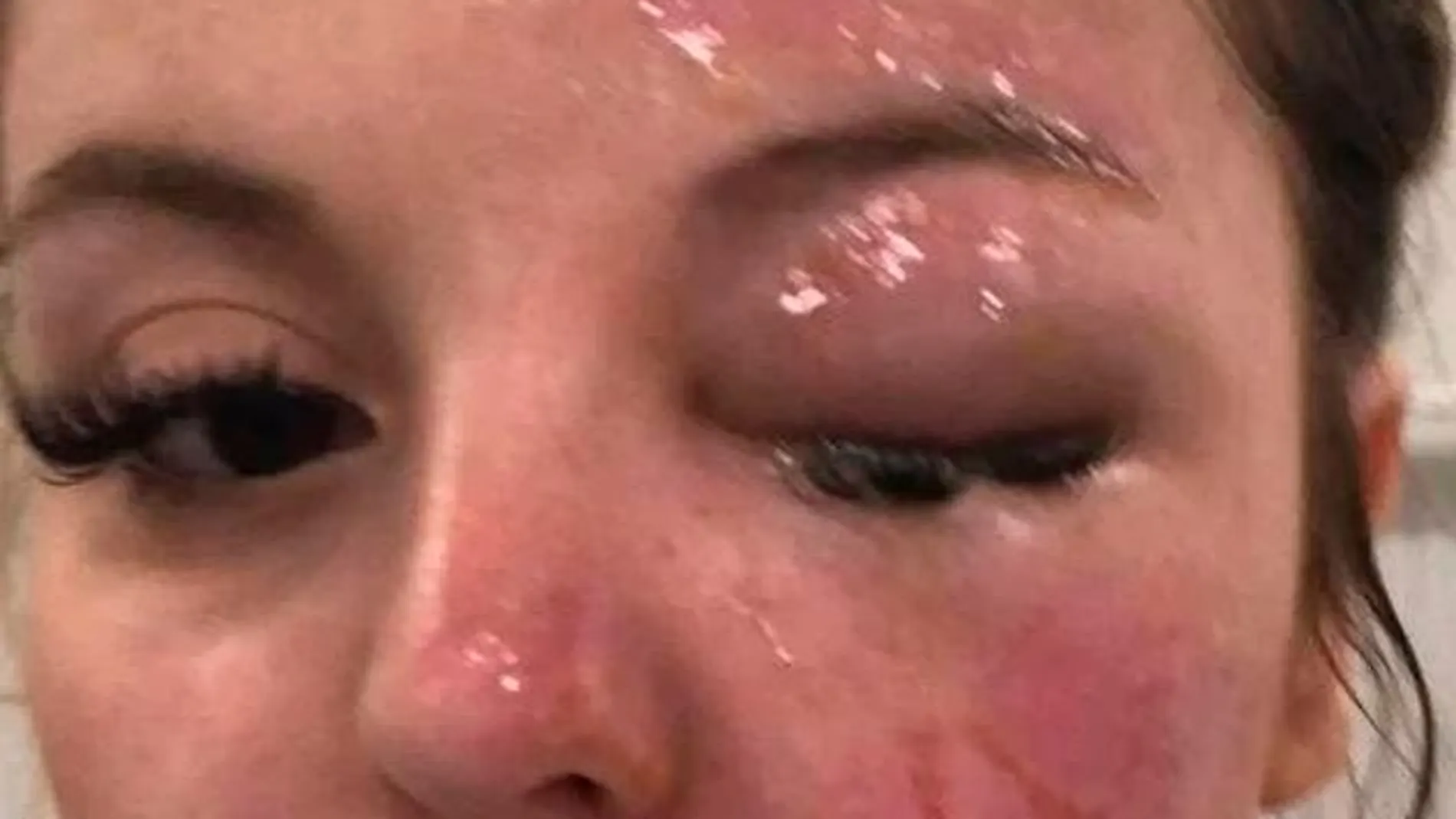 La joven sufrió graves quemaduras