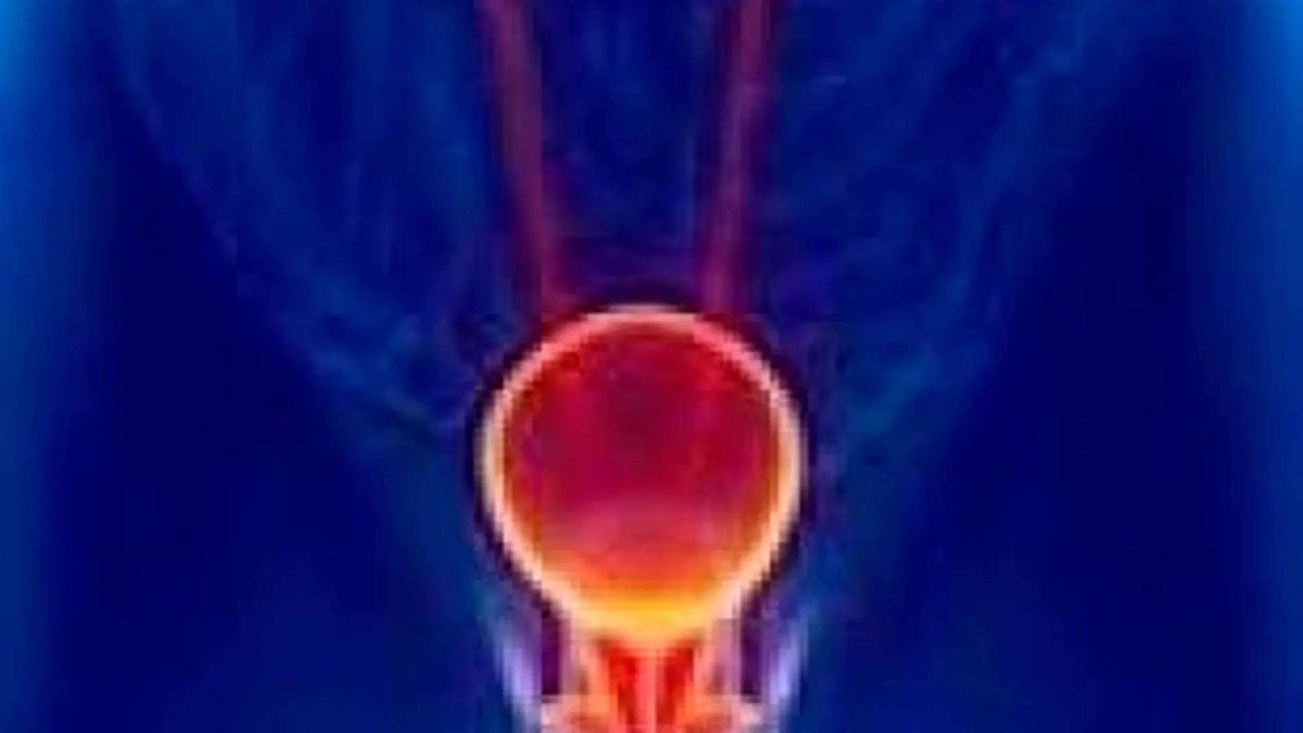 Esta prueba es el análisis para detectar si hay cáncer de próstata