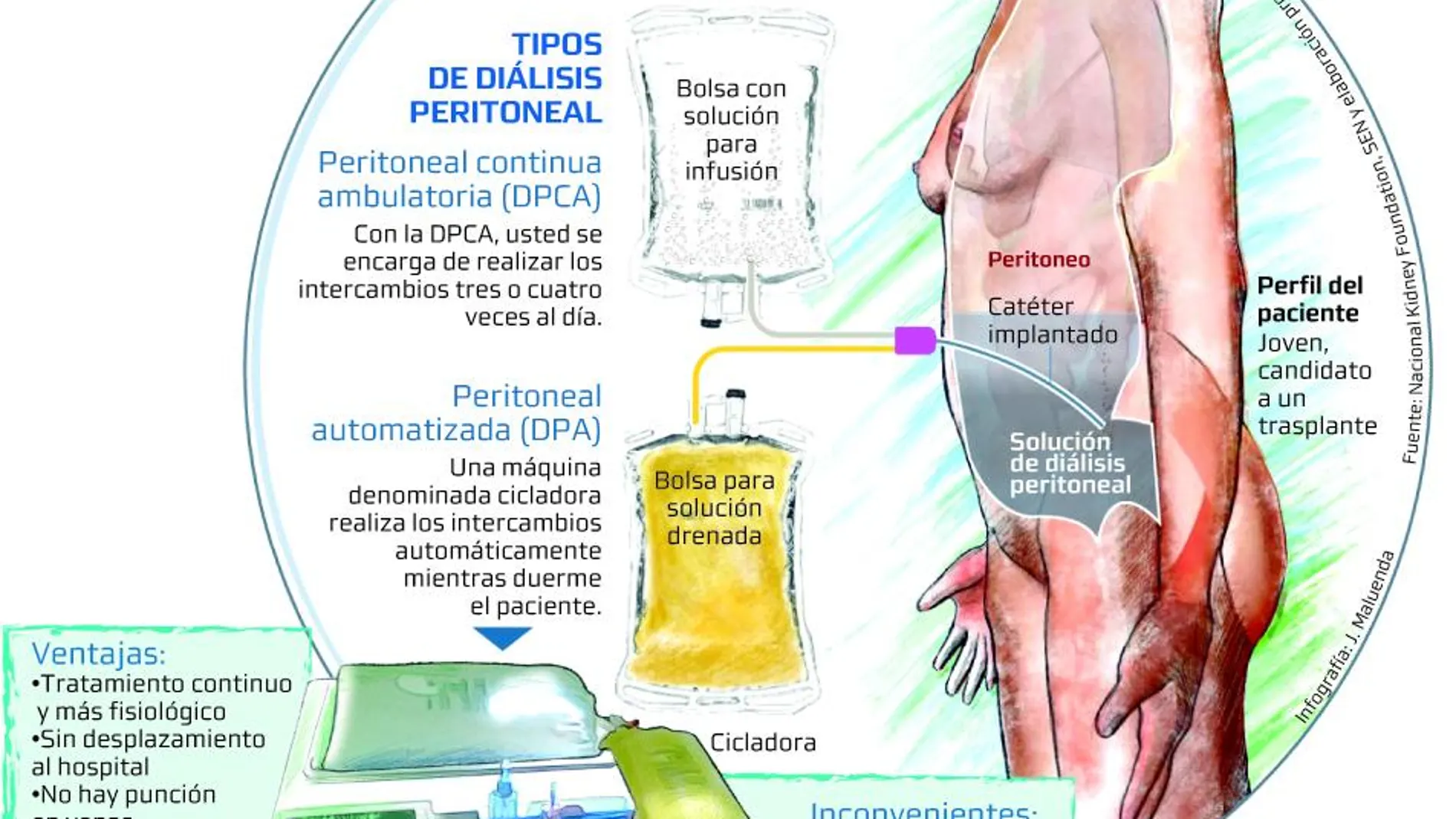 Hay dos tipos de diálisis: diálisis peritoneal continua ambulatoria DPCA y la diálisis peritoneal automatizada DPA.
