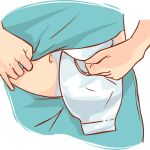 El 45% de las personas que se someten a esta cirugía no tienen bien hecho el marcaje en su abdomen