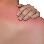 ¿Alergia al sol? Conoce las posibles causas para lograr un tratamiento adecuado