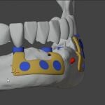 Primera prótesis dental 3D en España