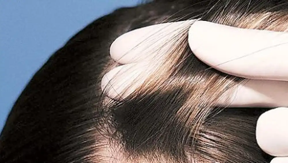 La alopecia traccional puede ser reversible en la mayoría de los casos