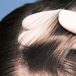 La alopecia traccional puede ser reversible en la mayoría de los casos
