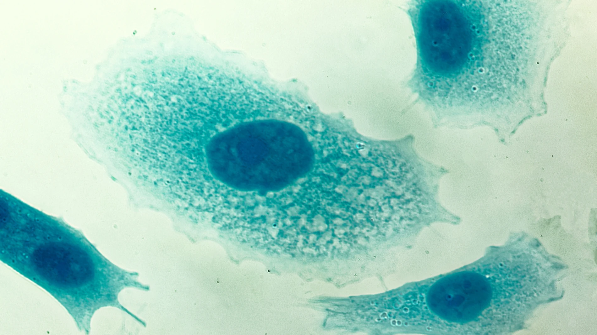 Células de cáncer de próstata